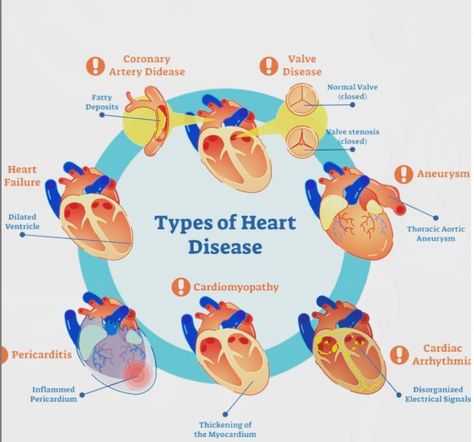 Learn more about cardiology by expert cardiologist - Dr Boon Lim Types Of Heart, Penyakit Jantung, Cardiac Nursing, Heart Muscle, Coronary Arteries, Medical Imaging, Cardiology, Nclex, Medical Information