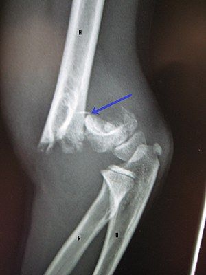 Humerus Fracture, Open Fracture, Radial Nerve, Ulnar Nerve, Normal Values, X-ray Images, Median Nerve, Bicep Muscle, Surgery