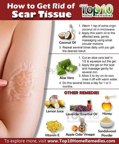 How to Get Rid of Scar Tissue | Top 10 Home Remedies Acne Face Mask Homemade, Get Rid Of Scars, Coconut Oil Massage, Getting Rid Of Scars, Scar Removal Cream, Acne Scar Removal, Face Acne, Scar Removal, Scar Tissue