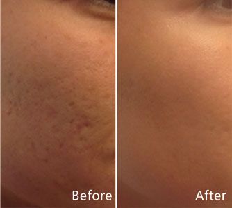 Profractional Laser, Acne Pictures, Fraxel Laser, Facial Before And After, Laser Acne Scar Removal, Skin Tightening Procedures, Different Types Of Acne, Laser Skin Tightening, Acne Treatments