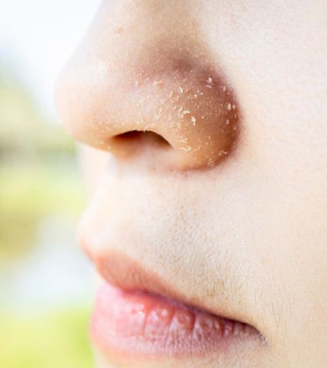 10 Remedies To Heal Dry Skin Around The Nose Dry Nose Skin, Dry Nose Remedy, Dry Skin Home Remedies, Dry Peeling Skin, Chin Exercises, Baking Soda Benefits, Dry Nose, Healing Dry Skin, Dry Flaky Skin