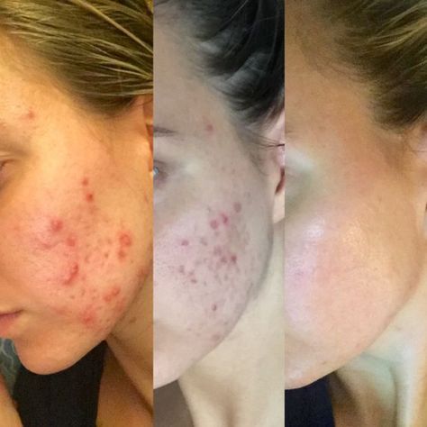 image Before And After Acne, Redness Pimple, Clear Skin Fast, Forehead Acne, Skin Care Pictures, Natural Acne Remedies, How To Get Rid Of Pimples, Cystic Acne, Acne Remedies