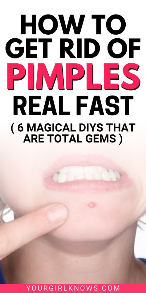 As much as we wish that acne didn't exist, sadly, they do. And when they do, almost all of us are searching for the best answers to how to get rid of acne fast? Natural Zit Remedy, Overnight Zit Remedy Fast, Diy Pimple Remover Fast, How Do You Get Rid Of Acne Fast, Get Rid Of Spots Overnight, How To Get Rid Of Spots Quickly, Diy Zit Remover Overnight, Get Rid Of Pimples Overnight Diy, How To Get Rid Of Blind Pimples