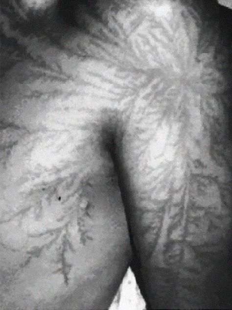 Lightening Scar, Survivor Show, Lightning Scar, Lichtenberg Figures, Struck By Lightning, Figure Photo, Lightning Strikes, Beautiful Body, Marauders Era