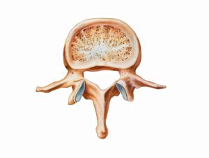 Spondylolisthesis is a spinal condition in which one vertebra slips forward over the vertebra below.  Degenerative spondylolisthesis, usually occurs in the lumbar spine, especially at L4-L5.  It is the result of degenerative changes in the vertebral structure that cause the joints between the vertebrae to slip forward.  This type of spondylolisthesis is most common among […] Brain And Spine, Spine Care, Hamstring Muscles, Spinal Column, Tight Hamstrings, Lumbar Spine, Muscle Weakness, Ct Scan, Muscle Spasms