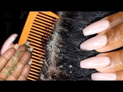 Scalp scratching and picking | Satisfying Dandruff Removal ASMR | Psoriasis - Yo...,  #ASMR #Dandruff #picking #Psoriasis #Removal #Satisfying #scalp #scratching #Yo Check more at https://hairsmoothening.com/scalp-scratching-and-picking-satisfying-dandruff-removal-asmr-psoriasis-yo/ Scalp Psorasischic, Scalp Bumps, Dandruff Scratching, Pimples On Scalp, Shampoo Diy, Dandruff Removal, Hair Mask For Dandruff, Dandruff Causes, Dandruff Solutions