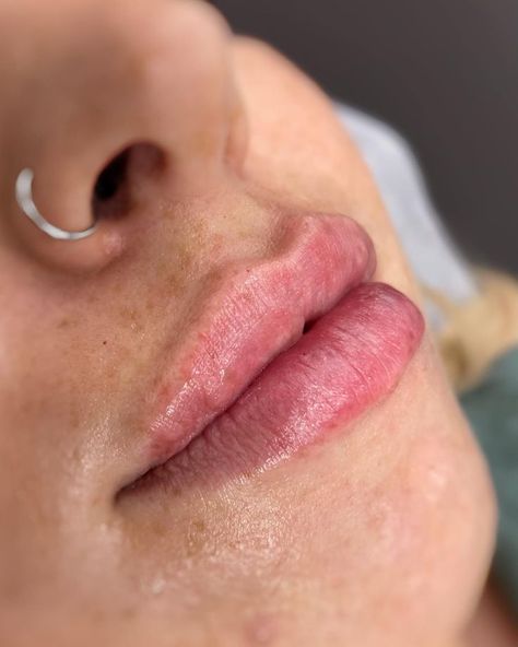 Using Juvederm filler to achieve that amazing lip filler result ladies crave. Lip Fillers Juvederm, Injectables Fillers, Lip Filler, Lip Enhancement, Lip Injections, Natural Lip, Dermal Fillers, Lip Fillers, Natural Lips