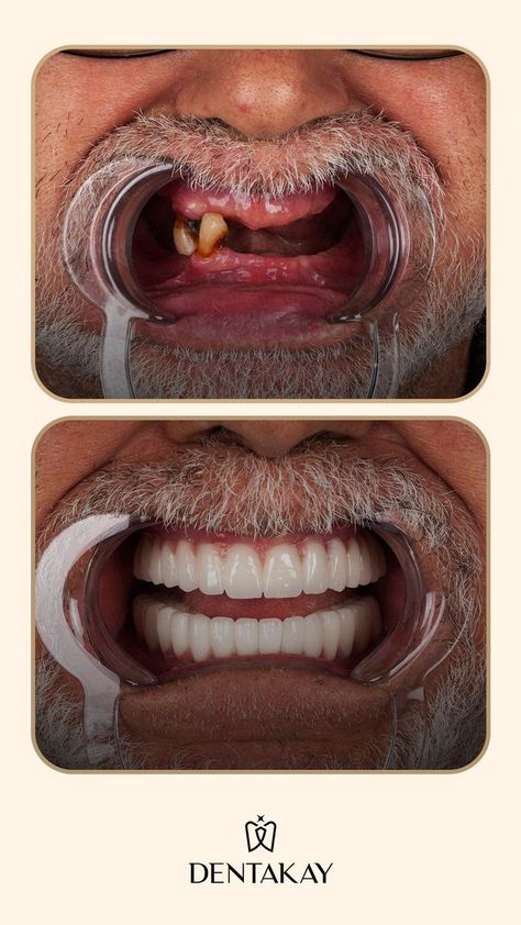 Hollywood Smile, Implant Dentistry, Dental Implant, Dental Problems, Dental Implants, Dental Health, Career, Hollywood, Social Media