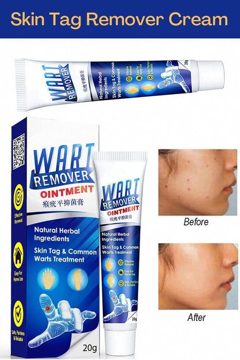 #AllNaturalHomeRemedies #NaturalHealthVitamins Wart Cream, Home Remedies For Warts, Remove Skin Tags Naturally, Warts Remedy, Wart Remover, Tag Remover, Losing 40 Pounds, Home Remedy For Cough, Skin Tags