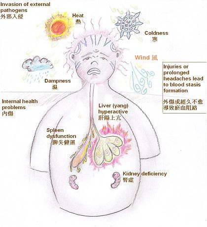 TCM Views on the Development of Headaches Forehead Headache, Chinese Healing, Traditional Chinese Medicine Acupuncture, Tcm Traditional Chinese Medicine, Kapha Dosha, Deficiency Symptoms, Eastern Medicine, Chinese Herbal Medicine, Energy Yoga