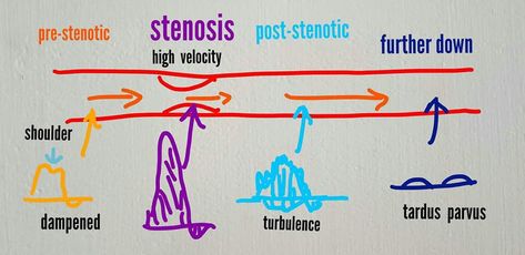 Vascular Sonography, Vascular Ultrasound Registry, Ultrasound Physics Spi, Diagnostic Medical Sonography Student, Ultrasound School, Arteries Anatomy, Ultrasound Physics, Medical Radiography, Abdominal Aorta