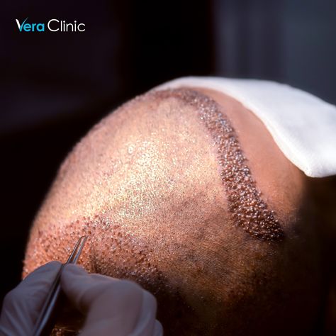 Unlocking a new level of confidence with the power of hairline and crown restoration through hair transplant in Turkey! 🌟 Get your FREE consultation! 📞 www.veraclinic.net #veraclinic #hairtransplant #hairtransplantturkey #hairtransplantation #hairtransplantclinic #turkeyhairtransplant #ozontherapy #dhi #sapphirefue #3500grafts #4000grafts #4500grafts #hairtransplantreviews #sapphirehairtransplant #hairtransplantbeforeafter #womanhairtransplant #afrohairtransplant Best Hair Transplant, Hair Transplant, Womens Hairstyles, Cool Hairstyles, Hair