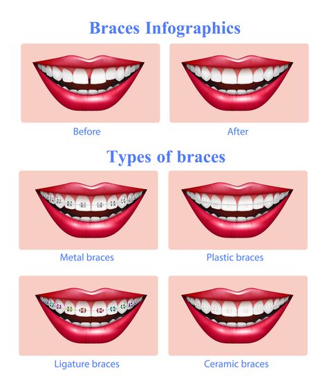 Braces Infographics Braces Types, Red Glossy Lips, Opened Mouth, Ceramic Braces, Braces Cost, Types Of Braces, Dental Braces, Orthodontics Braces, Metal Braces