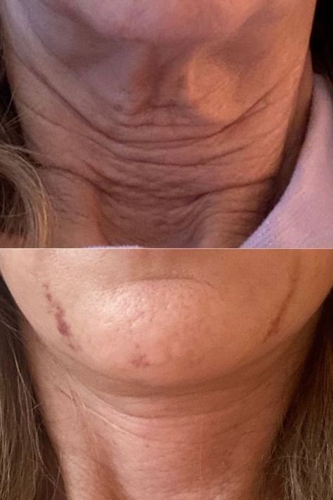 Say goodbye to neck wrinkles! Explore effective treatments and unlock the secrets to a smoother, youthful-looking neck. How To Remove Neck Lines, Neck Wrinkles Remedies, Loose Neck Skin, Tighten Neck Skin, Creamed Turkey, Turkey Neck, Neck Wrinkles, Neck Cream, Beauty Images