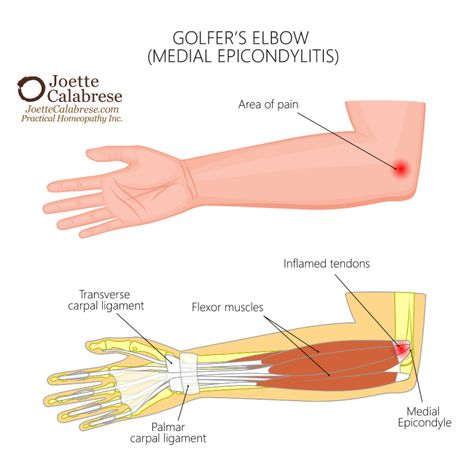 Homeopathy for Elbow Pain Elbow Anatomy, Scraping Therapy, Elbow Exercises, Cubital Tunnel Syndrome, Ulnar Nerve, Golfers Elbow, Soft Tissue Injury, Elbow Pain, Nerve Pain Relief