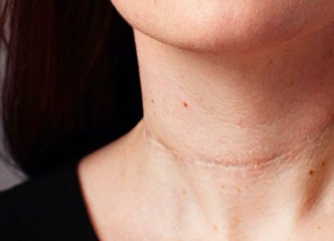 Scars All Over Body Drawing, Cheek Scar Reference, Neck Scar Reference, Glasgow Smile Scar, Struck By Lightning Scar, Scar Across Face, Scar Reference Art, Facial Scar Reference, Chin Scar