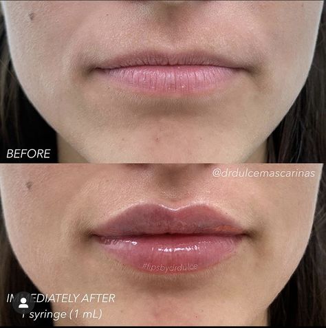 Lip Fillers Juvederm, Dermal Fillers Lips, Lips Inspiration, Permanente Make-up, Face Fillers, Botox Lips, Facial Fillers, Facial Aesthetics, Lip Filler