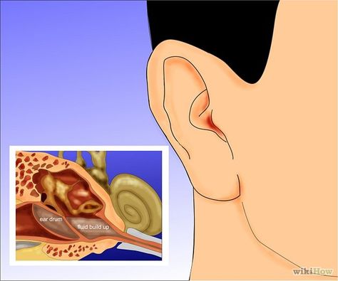 How to Remove Fluid in Ears: 10 Steps (with Pictures) - wikiHow How To Unstop Ears, Fluid Behind Eardrum, Drain Ear Fluid, Ear Ache Relief, Swimmers Ear Remedy, Ear Drainage, Ear Congestion, Fluid In Ears, Clogged Ears