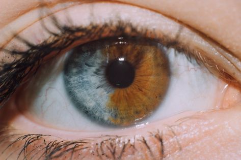 In people affected by complete heterochromia, one iris is a different color from the other. Segmental heterochromia occurs when areas of the same iris are different in color. 11.12.2017 Cat Eye Syndrome, Sectoral Heterochromia, Bowie Eyes, Hair Whorl, Heterochromia Eyes, Beautiful Eyes Color, Different Colored Eyes, Eye Photography, Aesthetic Eyes