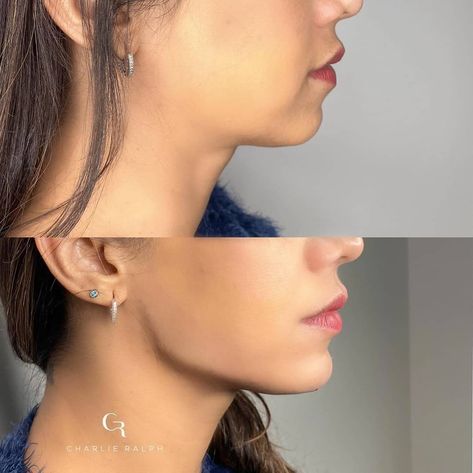 Jawline Filler, Jaw Reduction Surgery, Face Plastic Surgery, Chin Filler, Chin Implant, Face Fillers, Face Surgery, Jaw Surgery, Cheek Fillers