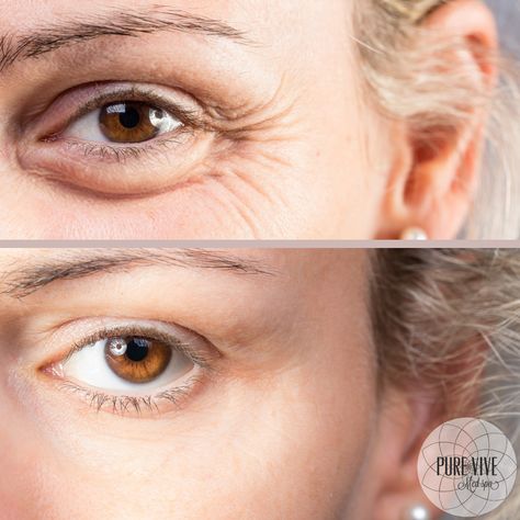 Face Botox Before And After, Botox Eyes, Botox Before And After, Before After Photo, Before And After Pictures, Med Spa, Eye Bags, Cincinnati, Your Eyes