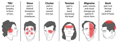 Headache Behind Left Eye, Headache Top Of Head, Headache Map, Types Of Headaches Chart, Headache Behind Eyes, Headache Chart, Different Headaches, Tension Migraine, Tension Headache Relief