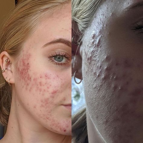 Texture Tuesday | Acne | Acne Happens | Acne Positivity Acne Positive, Acne Aesthetic, Acne Photos, Girl With Acne, Acne Positivity, Skin Positivity, Acne Beauty, Celebrity Acne, Bad Acne