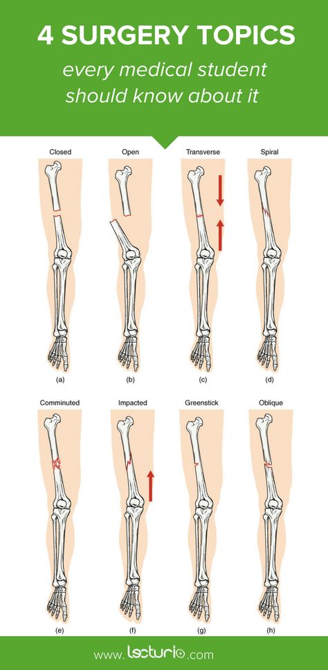 Medical Facts Medicine, Basic Medical Knowledge, Basic Medicine Knowledge, Medical Terms Cheat Sheets, Orthopedic Anatomy, Lower Limb Anatomy Mnemonics, Bone Fractures Types Of, Orthopedic Nursing, Perioperative Nursing