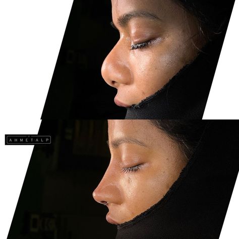 Case of the day 👃 We tried to do the best 👌 Came from USA 🇺🇸 Rib cartilage used 👍 #nosework #nasenkorrektur #ethnicrhinoplasty… | Instagram Black Nose Job, Finesse Rhinoplasty, Nose Job Inspiration Natural, Roxanne Core, Bulbous Nose Rhinoplasty Before After, Plastic Surgery Aesthetic, Nose Plastic Surgery, Rhinoplasty Recovery, Ethnic Rhinoplasty