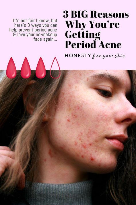 This is your ultimate guide to hormonal breakouts, period pimples and acne before your period. Plus how to get clear, calm, happy skin. Period Acne, Period Pimples, Chin Breakouts, Back Acne Remedies, Blind Pimple, Hormonal Breakouts, Scar Removal Cream, Pimples Overnight, Prevent Pimples