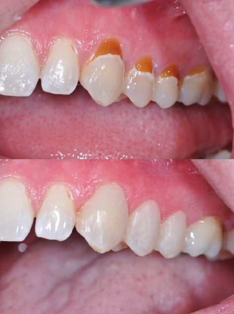 Tooth colored (composite) fillings look very natural.  There are many shades to choose from to match every color tooth. Composite Fillings Tooth, Good Teeth, Loose Teeth, Happy Dental, Dental Pictures, Composite Fillings, Dental Photos, Dental Images, Chipped Tooth