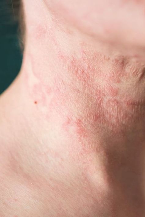 #Wellness #Home #Solutions #for #HealthyLiving #Workout #Common #Remedies #Natural #HealthTips #Ailments Rash On Face, Rash On Neck, Remove Skin Tags Naturally, Itchy Rash, Body Hair Removal, Unwanted Hair Removal, Homemade Face, Unwanted Hair, Skin Conditions