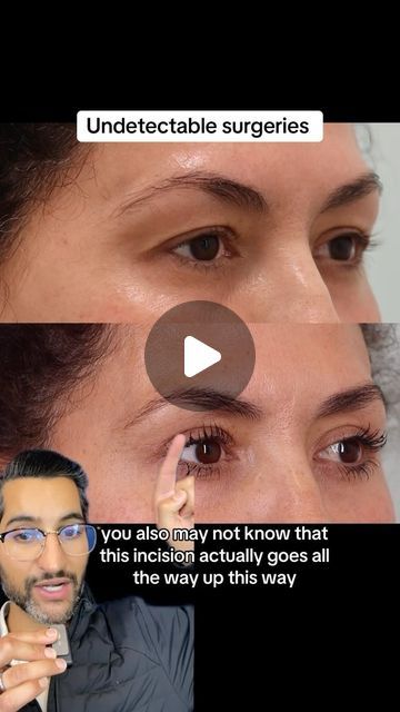 Prem Tripathi, MD on Instagram: "Everyone wants undetectable results, and we’re here for it. 

Upper eyelid surgery is truly transformative and will keep you looking like yourself, but just refreshed. 

Every surgeon uses a different technique, but I got you 😁

Ready for yours?
📆 direct online booking in bio 
📱925-272-9998

#drpremtripathi #facialplasticsurgery #alamoca" Eyelid Surgeries, Facial Plastic Surgery, Upper Eyelid, I Got You, All The Way, Surgery, Like You, Beauty Hacks, On Instagram