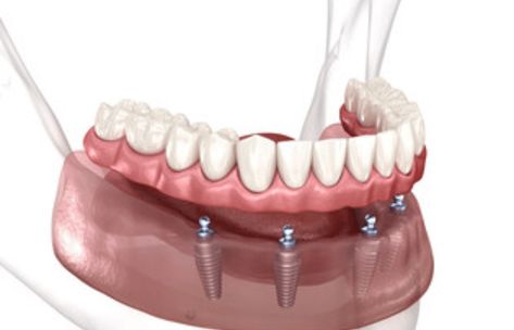 All-on-4 Dental Implants Advantages All On 4 Dental Implants, Dental Implants Cost, Tooth Replacement, Teeth Implants, Dental Implants, Arch, Technology