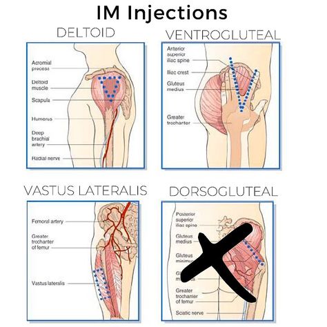 Review of IM Injections💉⁣ ⁣ The 3️⃣ preferred sites are deltoid, ventrogluteal, and vastus lateralis. The dorsogluteal site is avoided… Im Injection, Instagram Review, Needle Gauge, Adipose Tissue, Sciatic Nerve, Index Finger, Registered Nurse, Primary Care, Blood Vessels