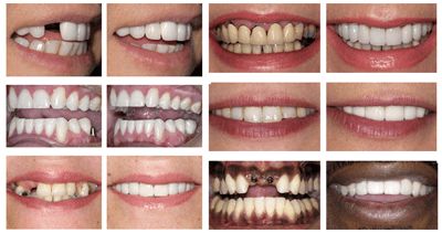 implant teeth before and after preview Teeth Implants Before And After, Teeth Before And After, Dentures Before And After, Dental Implants Before And After, Byte Aligners Before And After, Clear Choice Dental Implants, All On 4 Dental Implants, Benefits Of Dental Implants, Missing Teeth