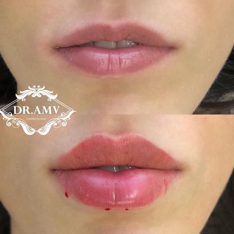 Lip Fillers Juvederm, Lips Fillers, Natural Lip Plumper, Lips Shape, Rhinoplasty Nose Jobs, Lips Inspiration, Face Fillers, Botox Lips, Facial Fillers