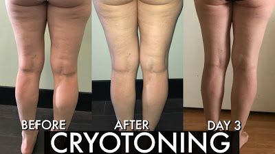 Cryo Toning Before and After - Helps diminish the appearance of cellulite, fine lines, and wrinkles. Boosts the production of collagen which elminates cellulite, tones the area, improves skin elasticity, and reduces pore size. Cryoskin Before And After, Cryo Facial Before And After, Cryoslimming Before And After, Collagen Benefits Before And After, Lipedema Before And After, Facial Before And After, Body Makeover, Reduce Pore Size, Collagen Benefits