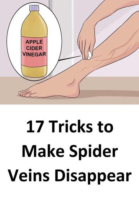 Spider Vein Remedies, Vericous Veins, Varicose Vein Remedy, Get Rid Of Spiders, Vein Removal, Natural Skin Care Remedies, Skin Natural Remedies, Natural Cough Remedies, Natural Health Remedies