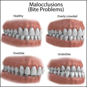 #CrookedTeeth and Your Overall #Health #Care #Richardson. Dental Animation, Dental Assistant Study, Fix Teeth, Misaligned Teeth, Buck Teeth, Lactobacillus Reuteri, Dental Anatomy, Crooked Teeth, Brace Face