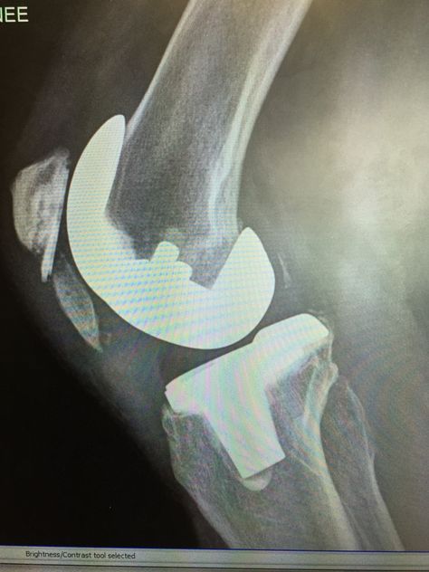 My knee cap has broken in half! The entire lower half of the patella is laying up against my knee replacement! Broken Knee, Patella Fracture, Knee Cap, Knee Replacement, Scammer Pictures