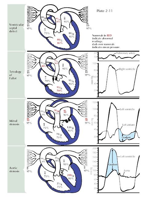 Cardiology Study, Cath Lab Nursing, Patent Ductus Arteriosus, Heart Pressure, Heart Catheterization, Cardiac Sonography, Atrial Septal Defect, Normal Sinus Rhythm, Mitral Valve