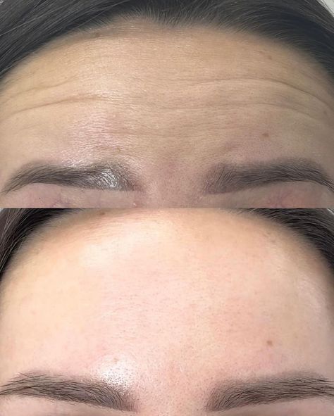 Check out our amazing before and after picture for effective botox solutions. Forehead Botox Before And After, Before And After Botox Pictures, Botox Before After, Neck Spasms, Botox Forehead, Teeth Clenching, Botox Before And After, Lazy Eye, Cambridge Ontario