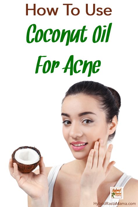 Do you know how to use coconut oil for acne? Hybrid Rasta Mama not only shares her insider tips for getting rid of acne fast but she also shows you have to make an awesome face wash to get rid of and prevent acne. #coconutoil #acne #acnetreatment #coconutoilandacne Coconut Oil For Acne, Acne Overnight, Treat Acne, Coconut Oil For Skin, Face Acne, Cystic Acne, Acne Remedies, How To Get Rid Of Acne, Prevent Acne