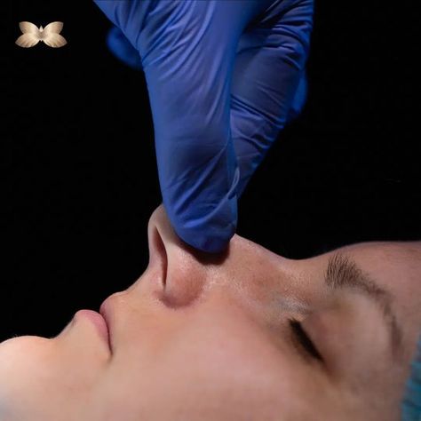 Rhinoplasty and Nostril Reduction Surgery Nostril Reduction, Reduction Surgery, Facial Plastic, The Shape, Surgery, Utah, Facial