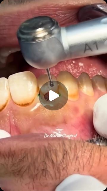 Dentistry on Instagram: "Post by • @dentistrysociety_ Deep Caries Removal ✨️
•
•
➖
📽By @dr_morad_shaglouf 
•

 #dent #dentallogo #dentalassistant #dentalcare #dentalinstruments

#dentist #dentista #dental #toothlessedit" Reverse Cavities Naturally, Dental Advice, Teeth Repair, Tooth Crown, Reverse Cavities, Dental Posts, Tooth Repair, Dental Fun, Dental Logo