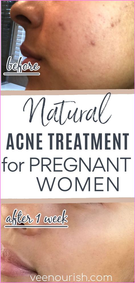 Skin Care For Pregnant Women, Acne Skin Care Products, Pregnancy Safe Skin Care, Pregnancy Remedies, Pregnancy Acne, Hormonal Acne Remedies, Acne Products, Pregnancy Skincare, Face Care Tips