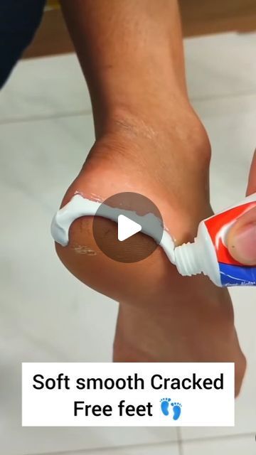 Mysha beauty queen (influencer) on Instagram: "😇Homemade cracked heel cream for soft supple feet ...  Follow for more ♥️  . . #crackedheels #cracedheel #crackedheelsremedy #crackedheelcream #homeremedy #reels #reelsgram #reelsinsta #reelsinstagram #reelitfeelit #trendingaudio #viral #ᴠɪʀᴀʟᴠɪᴅᴇᴏ#crackedheelcream #homeremedy #reels #reelsgram #reelsinsta #reelsinstagram #reelitfeelit #trendingaudio #viral #viralvideo" Vaseline Hacks For Skin, Diy Cracked Heel Remedy, How To Heal Cracked Heels, Heel Cracks Remedies, Soft Feet Remedy At Home, Cracked Heels Remedy, Cracked Heel Remedy, Soft Feet Remedy, Foot Cream For Cracked Heels