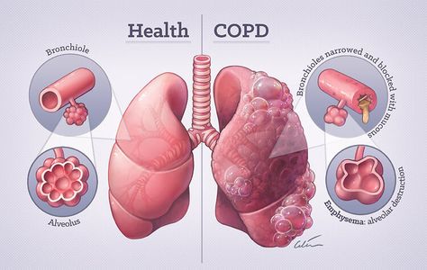 Portfolio - Medical Illustration by Dr Ciléin Kearns (Artibiotics) — artibiotics Home Remedies For Bronchitis, Hyperbaric Oxygen Therapy, Pulmonology, Chronic Obstructive Pulmonary Disease, Medical School Studying, Nursing School Notes, Pulmonary Disease, Lung Disease, Medical Art