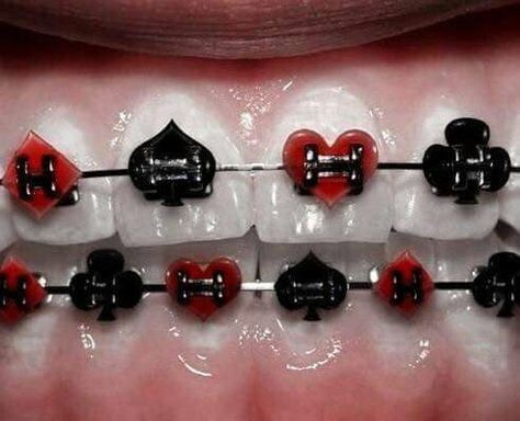 ♛ follow ya average girl for more pins ♛ Braces Ideas, Cute Braces Colors, Misaligned Teeth, Braces Tips, Getting Braces, Cute Braces, Lizzie Hearts, Crooked Teeth, Brace Face